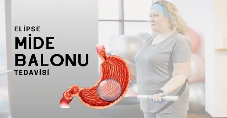 Yutulabilir Mide Balonu