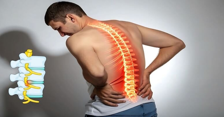 Bel Fıtığı Ameliyatı: Hangi Yöntem Daha Uygun ve Ne Zaman Gerekir?